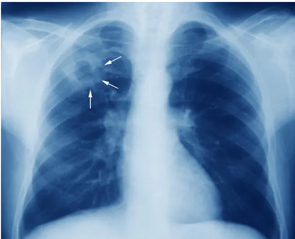 Viêm phổi kẽ: Nguyên nhân, triệu chứng và cách cải thiện bệnh 